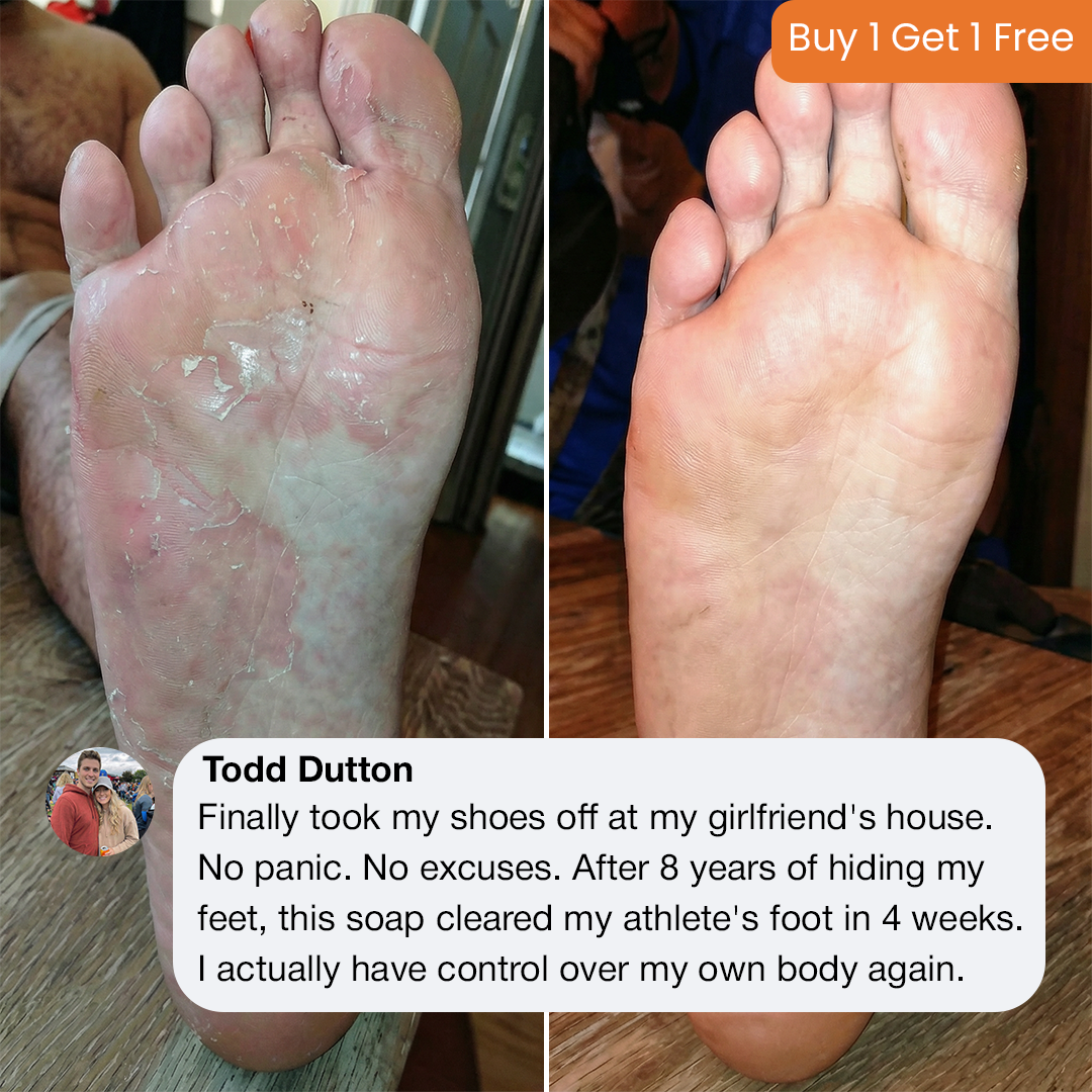 Kill Athlete's foot and persistent itching