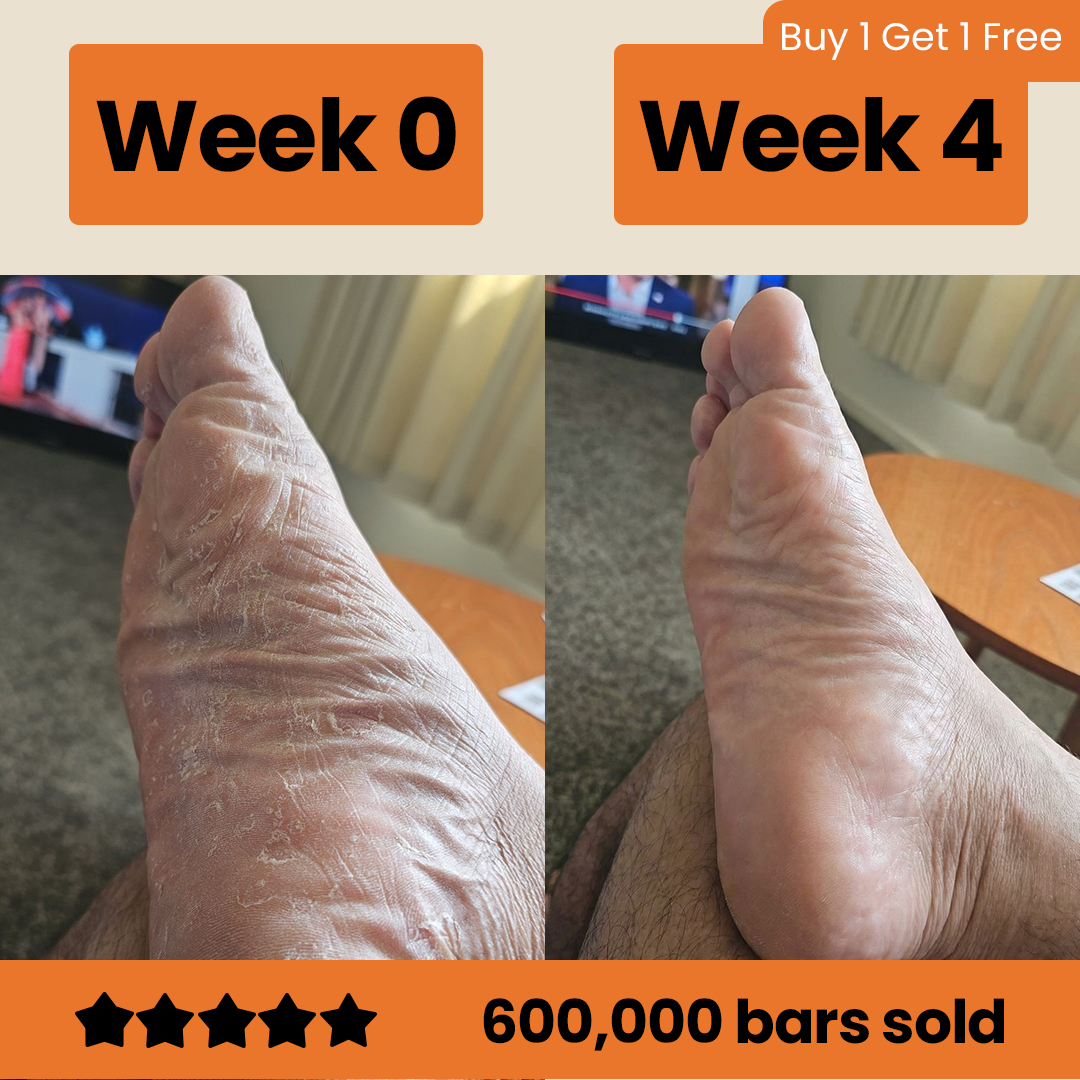 Kill Athlete's foot and persistent itching